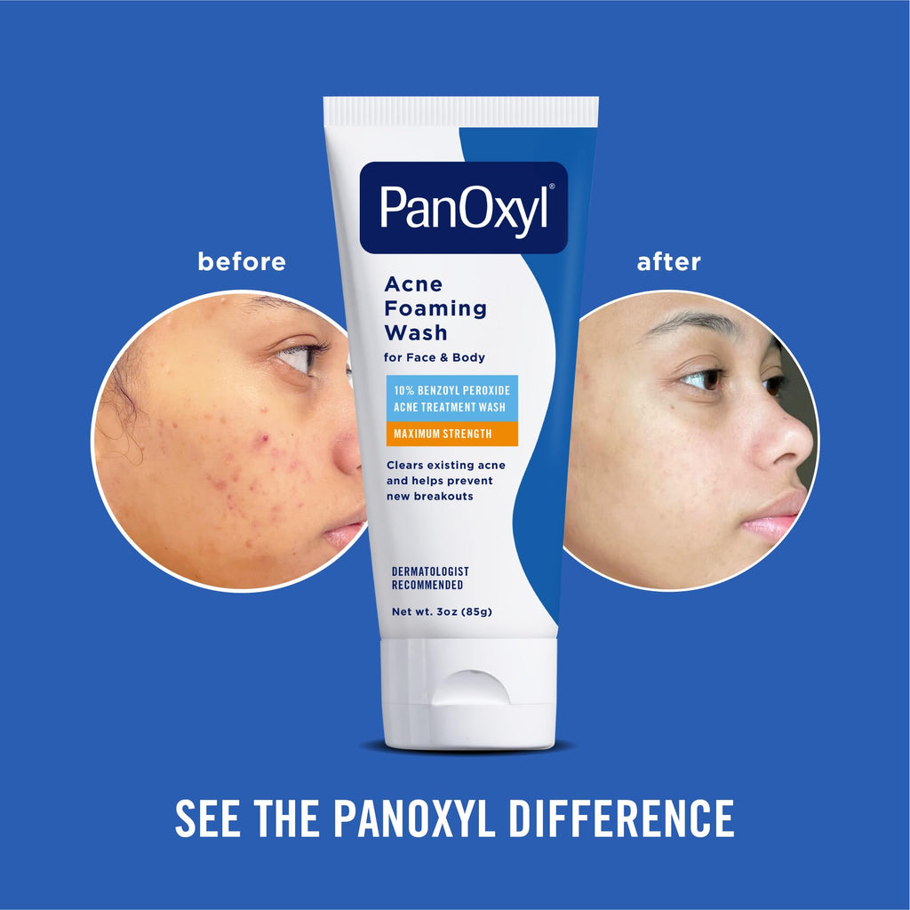 PanOxyl Acne Foaming Wash, 10% Benzoyl Peroxide, For Face & Body, 5.5 oz - Jansha Store