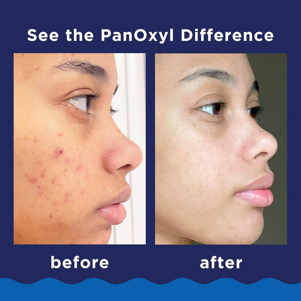 PanOxyl Acne Foaming Wash, 10% Benzoyl Peroxide, For Face & Body, 5.5 oz - Jansha Store