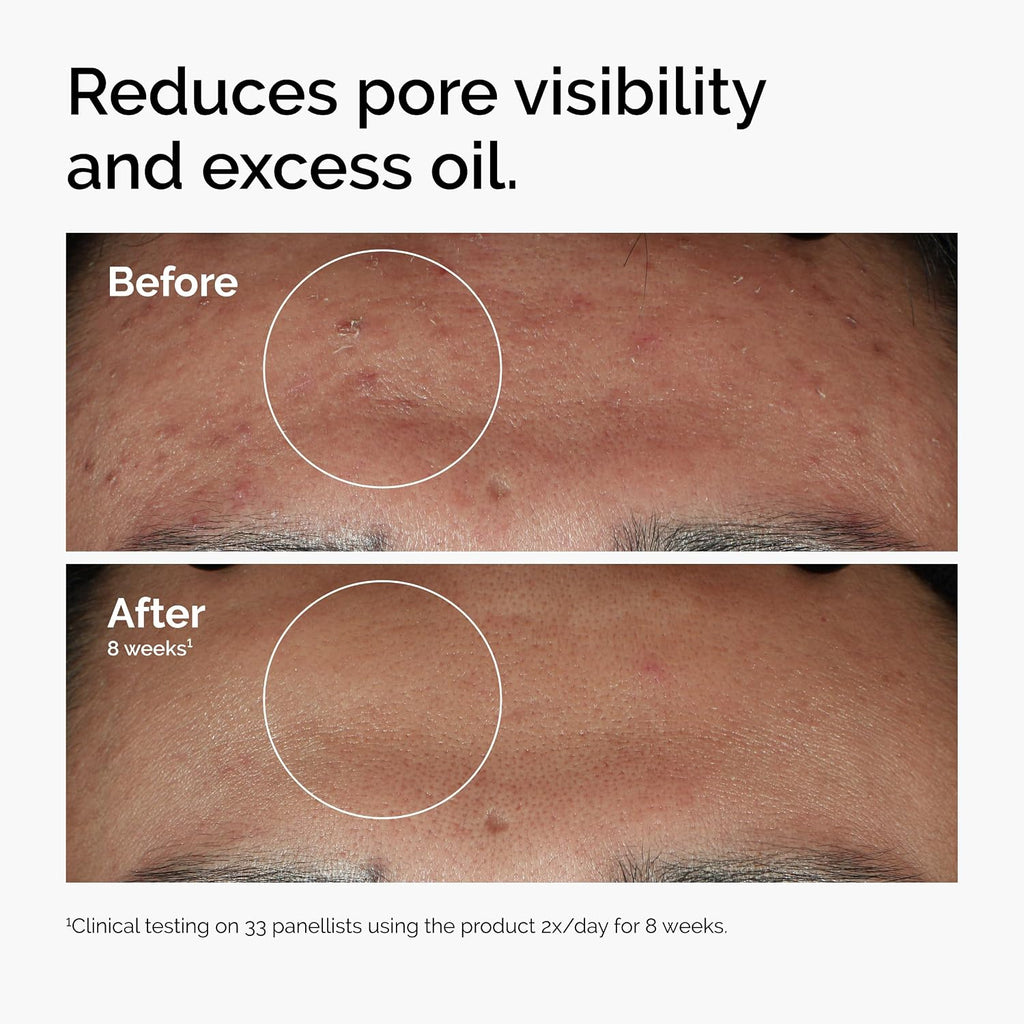 The Ordinary Niacinamide 10% + Zinc 1%, Smoothing Serum for Blemish-Prone Skin - Jansha Store